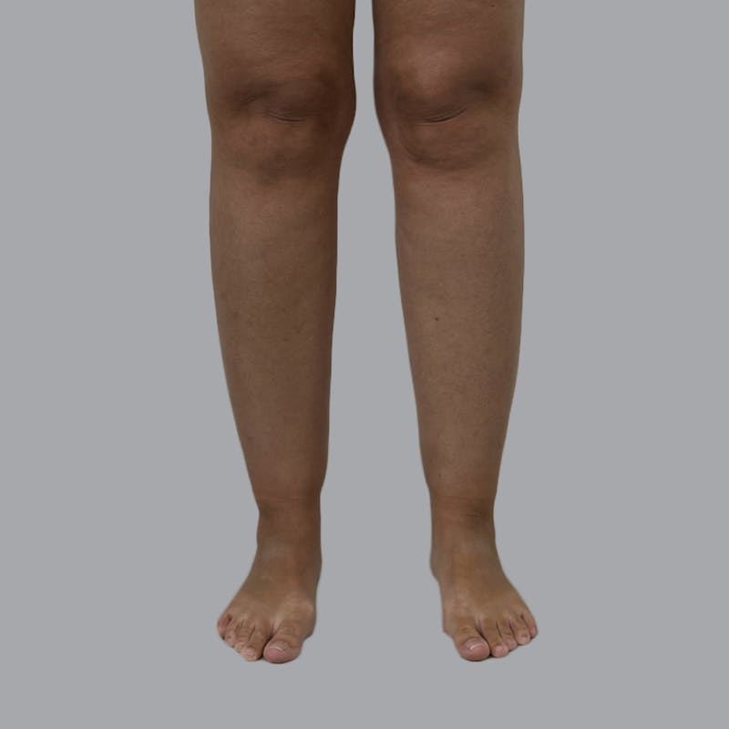Leg Liposuction Before & After Gallery - Patient 342772 - Image 1