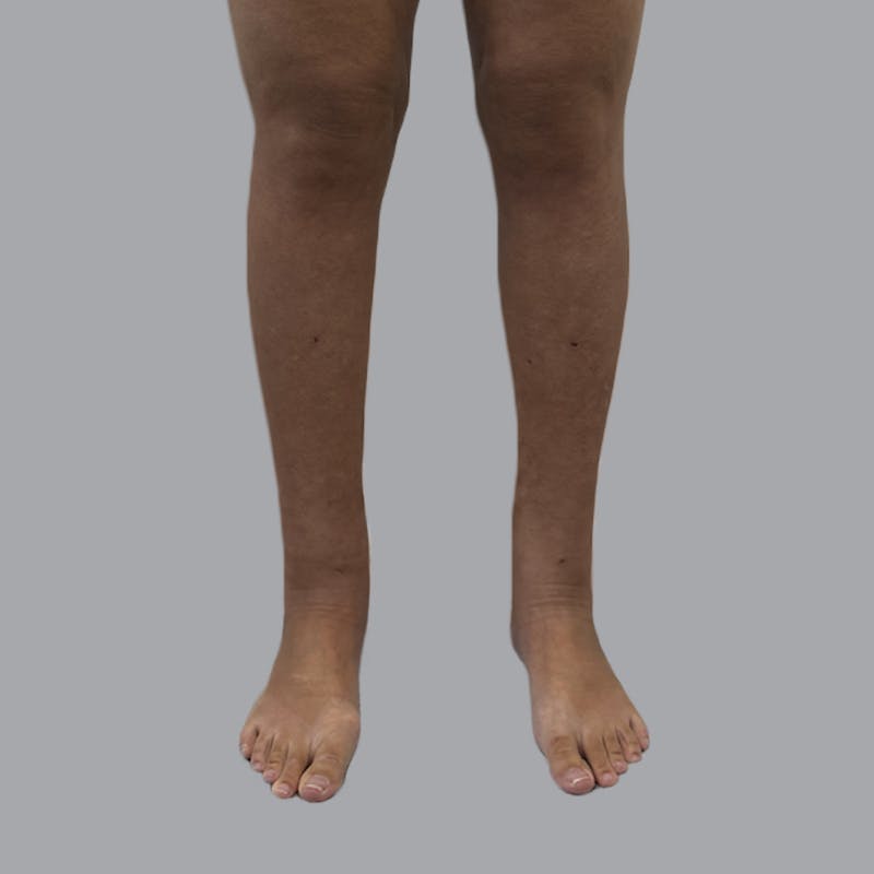 Leg Liposuction Before & After Gallery - Patient 342772 - Image 2