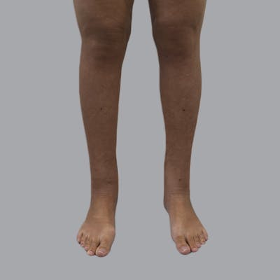 Lipedema Before & After Gallery - Patient 664870 - Image 2
