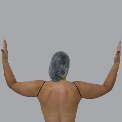 Lipedema Before & After Gallery - Patient 159112 - Image 1