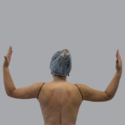 Lipedema Before & After Gallery - Patient 159112 - Image 2