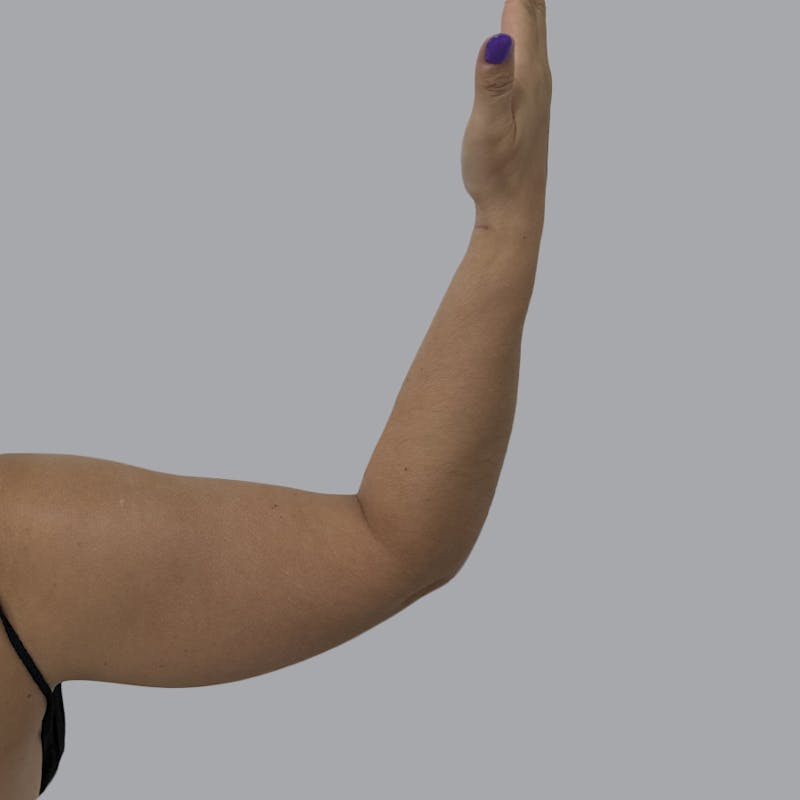 Arm Liposuction Before & After Gallery - Patient 417574 - Image 3