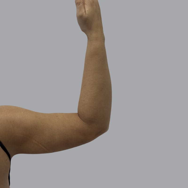 Arm Liposuction Before & After Gallery - Patient 417574 - Image 4
