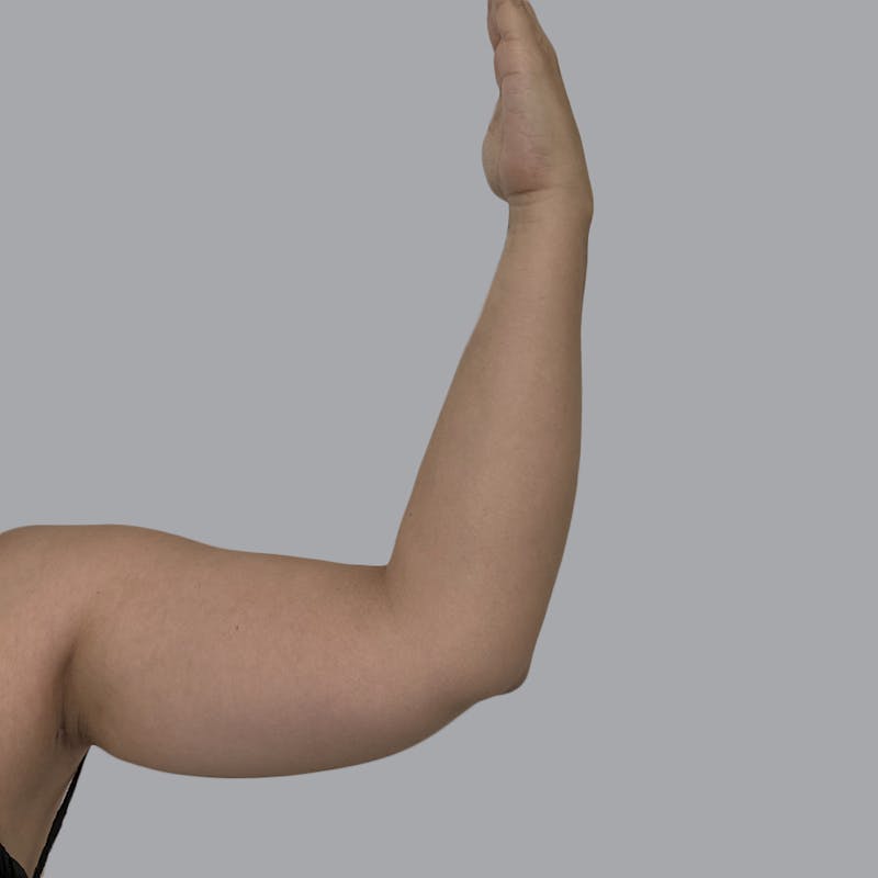 Arm Liposuction Before & After Gallery - Patient 417574 - Image 5