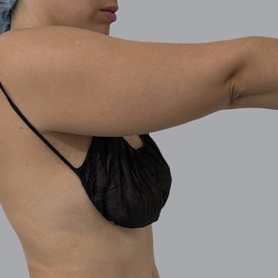 Lipedema Before & After Gallery - Patient 159112 - Image 7