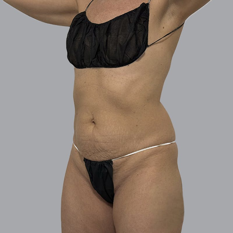 Abdominoplasty Before & After Gallery - Patient 130131 - Image 3