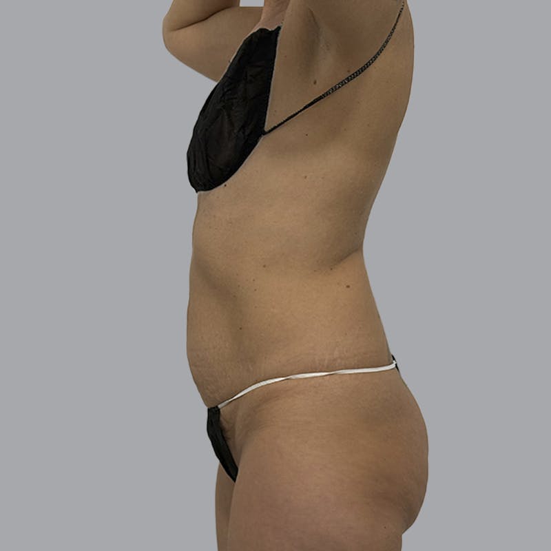 Abdominoplasty Before & After Gallery - Patient 130131 - Image 5