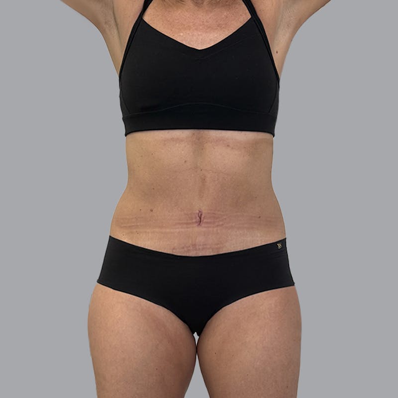 Abdominoplasty Before & After Gallery - Patient 130131 - Image 2