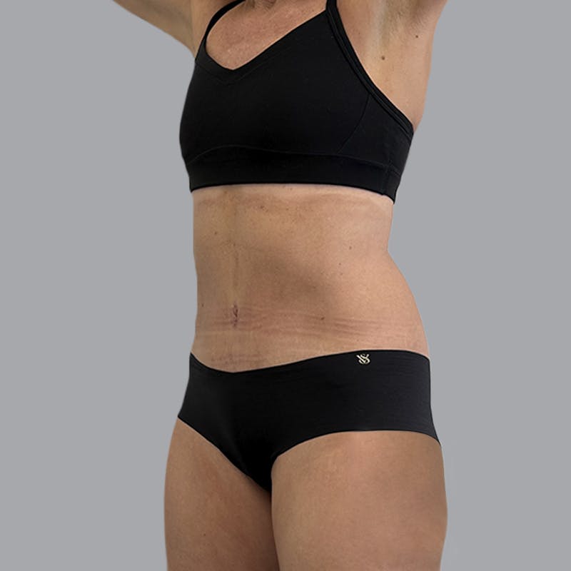 Abdominoplasty Before & After Gallery - Patient 130131 - Image 4