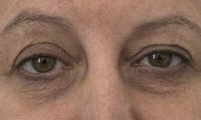 Blepharoplasty Before & After Gallery - Patient 634774 - Image 3