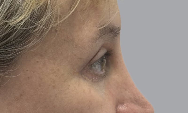 Blepharoplasty Before & After Gallery - Patient 634774 - Image 6