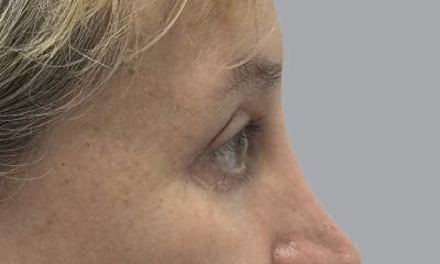Blepharoplasty Before & After Gallery - Patient 634774 - Image 6