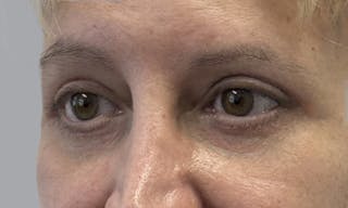 Blepharoplasty in Tampa Before & After Gallery - Patient 634774 - Image 2