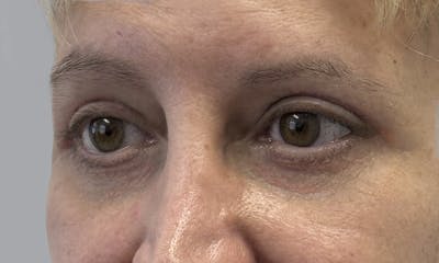 Blepharoplasty Before & After Gallery - Patient 634774 - Image 2