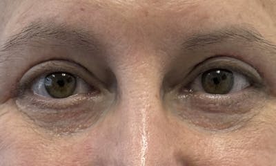 Blepharoplasty Before & After Gallery - Patient 634774 - Image 4