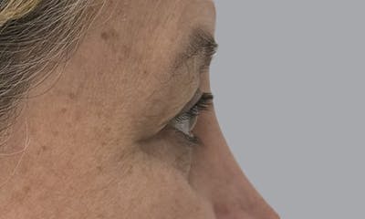 Blepharoplasty Before & After Gallery - Patient 634774 - Image 5