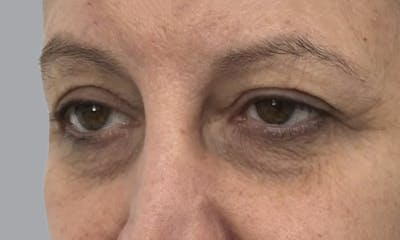 Blepharoplasty Before & After Gallery - Patient 634774 - Image 1