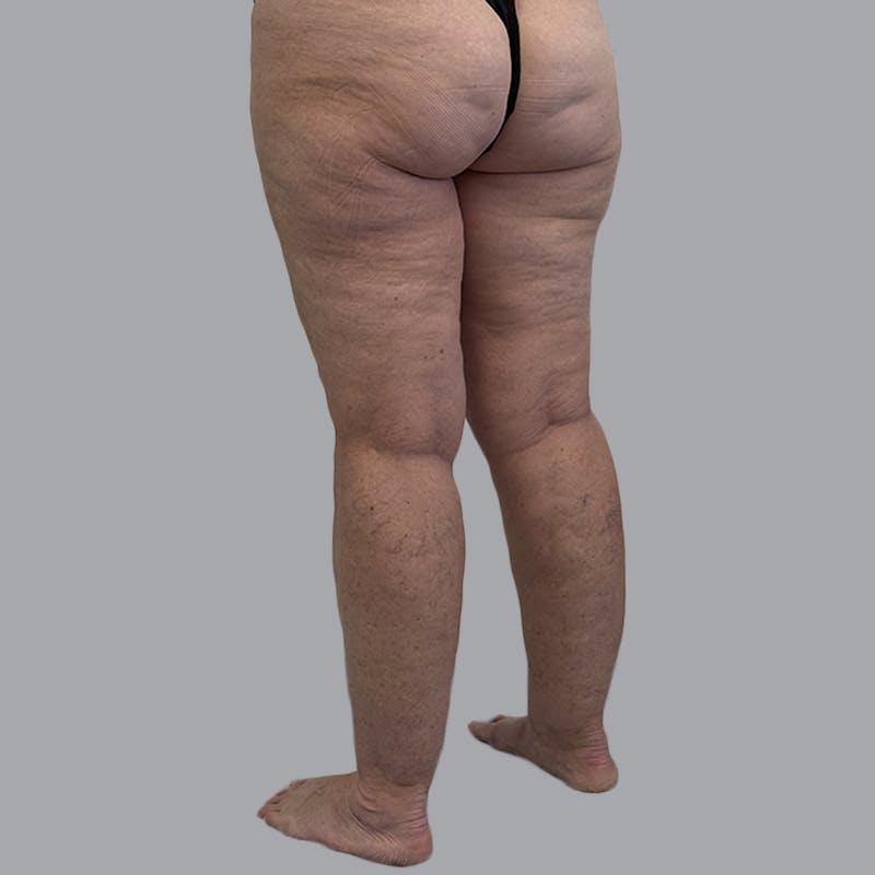 Lipedema Before & After Gallery - Patient 158452 - Image 7