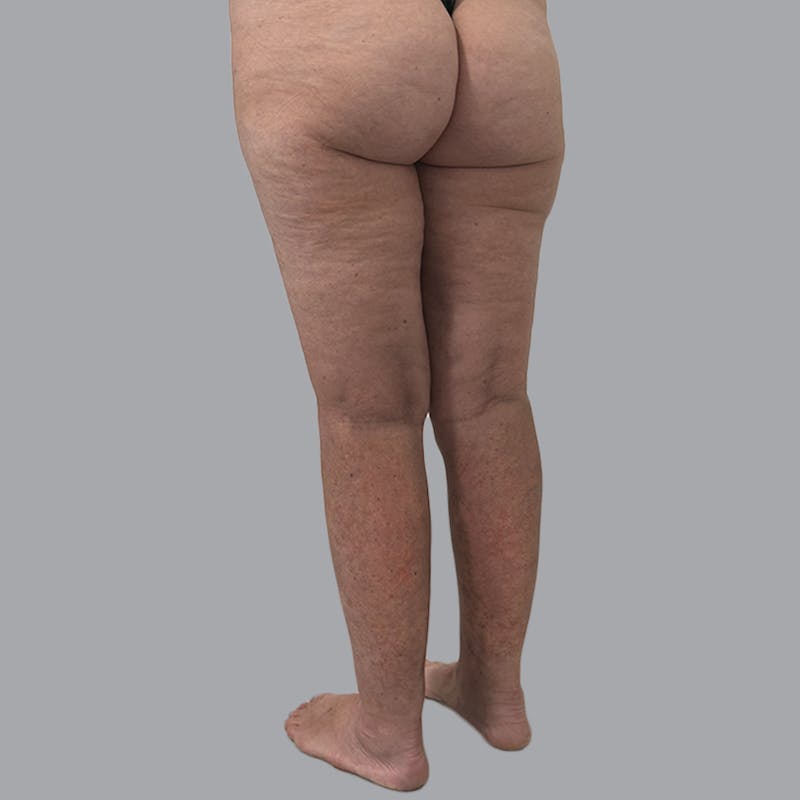 Lipedema Before & After Gallery - Patient 158452 - Image 8