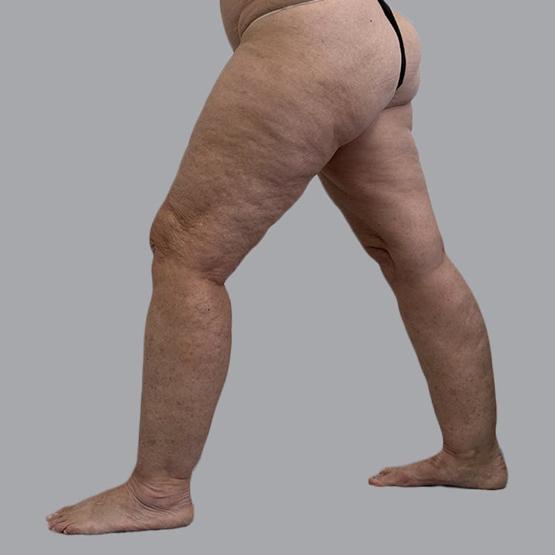 Lipedema Before & After Gallery - Patient 158452 - Image 9
