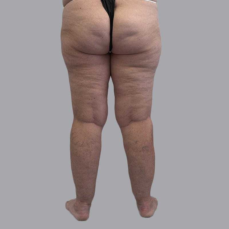 Lipedema Before & After Gallery - Patient 158452 - Image 3