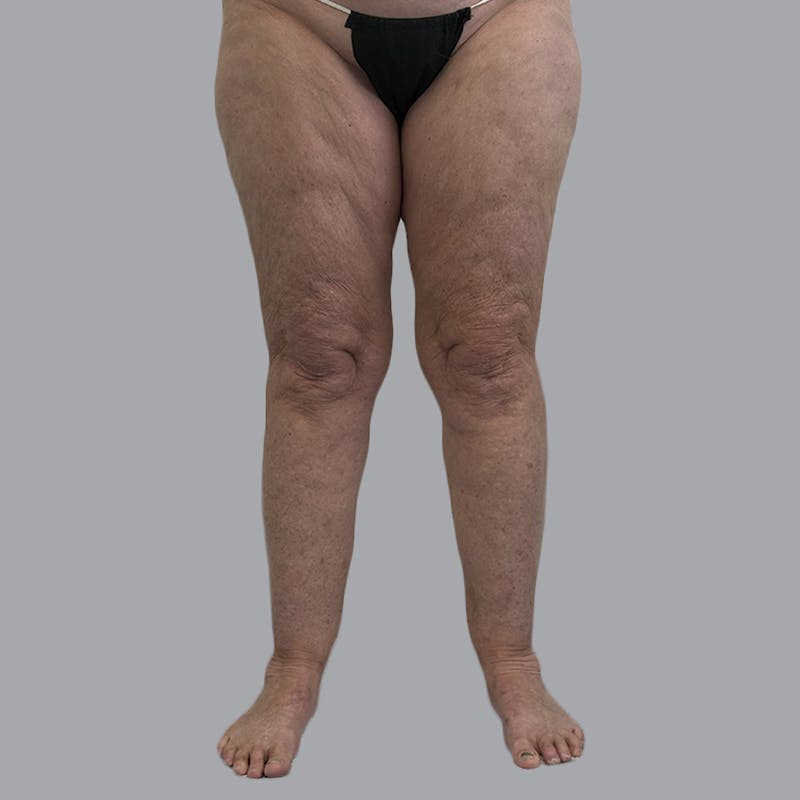 Lipedema Before & After Gallery - Patient 158452 - Image 1