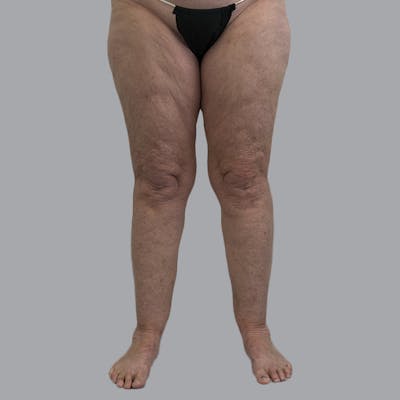Lipedema Before & After Gallery - Patient 158452 - Image 1