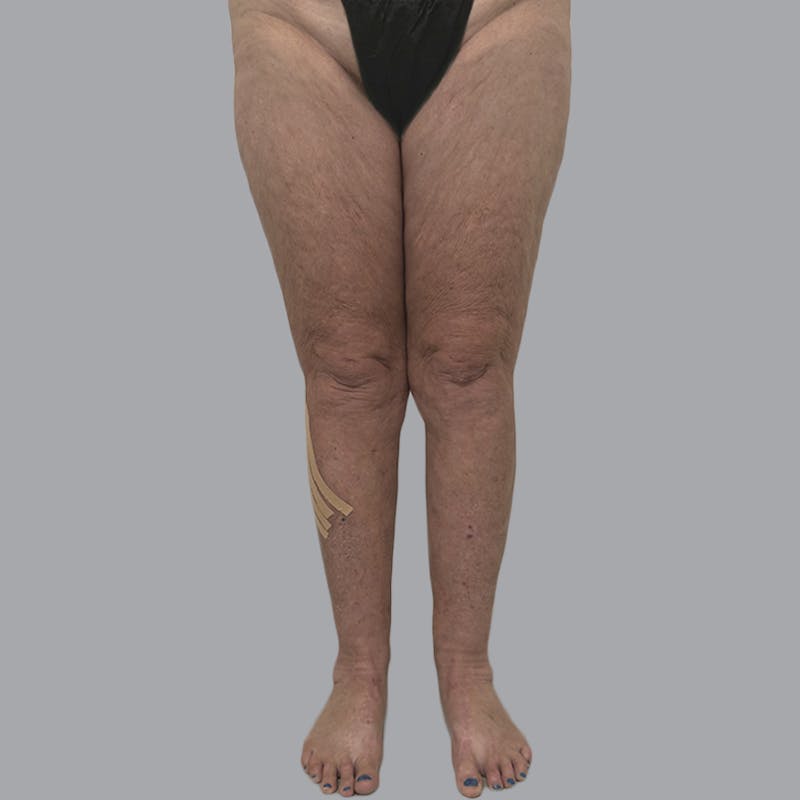 Lipedema Before & After Gallery - Patient 158452 - Image 2
