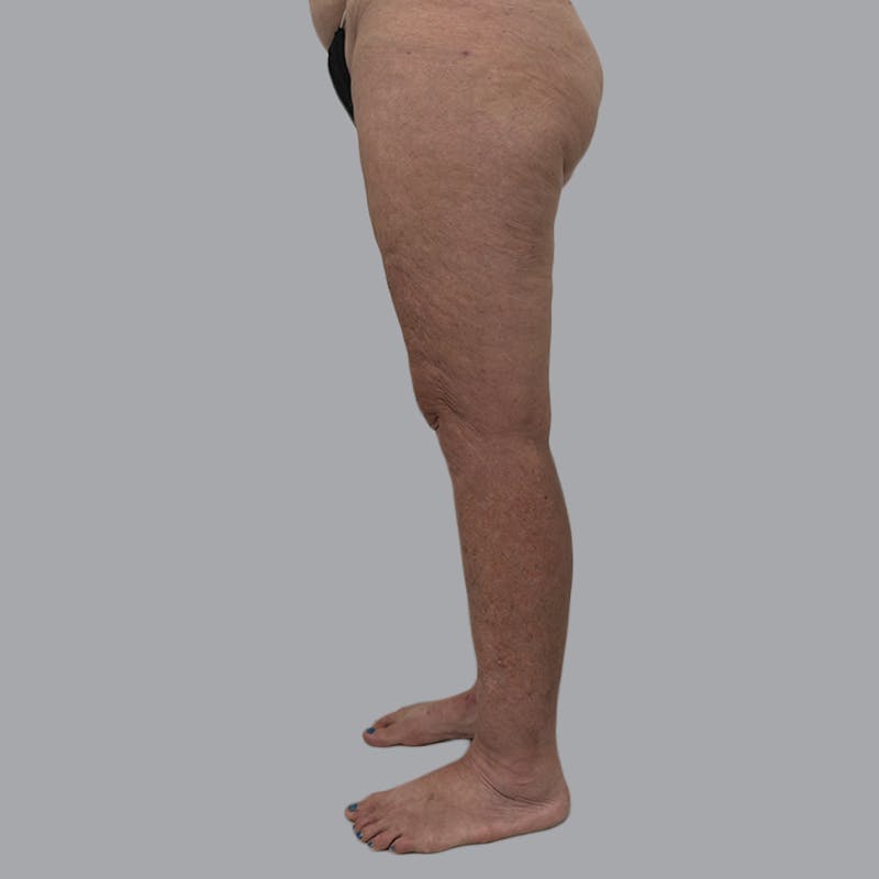 Lipedema Before & After Gallery - Patient 158452 - Image 6
