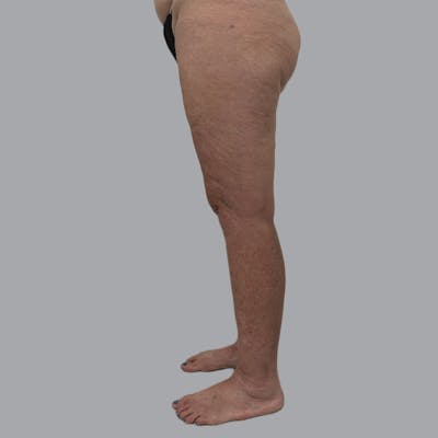 Lipedema Before & After Gallery - Patient 158452 - Image 6