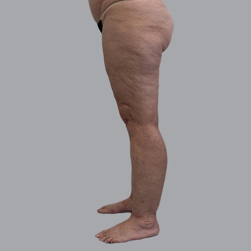 Lipedema Before & After Gallery - Patient 158452 - Image 5