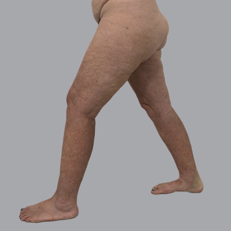 Lipedema Before & After Gallery - Patient 158452 - Image 10