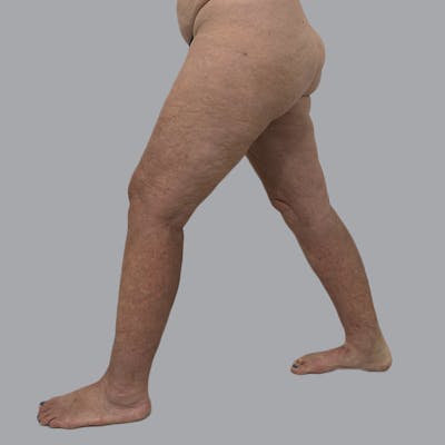 Lipedema Before & After Gallery - Patient 158452 - Image 10