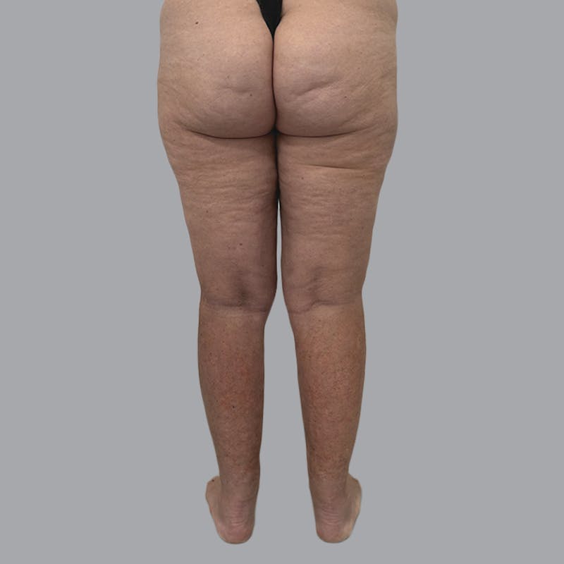 Lipedema Before & After Gallery - Patient 158452 - Image 4