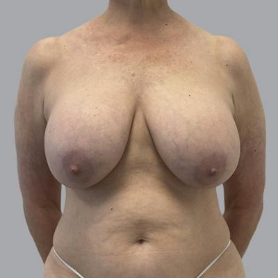 Breast Implant Removal Before & After Gallery - Patient 380462 - Image 1