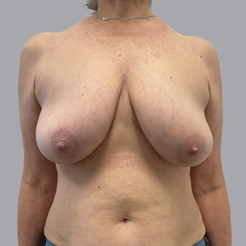 Breast Implant Removal Before & After Gallery - Patient 380462 - Image 2
