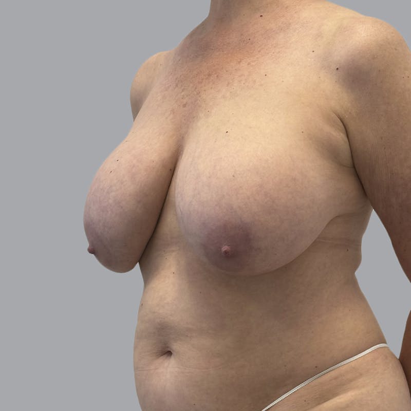 Breast Implant Removal Before & After Gallery - Patient 380462 - Image 3