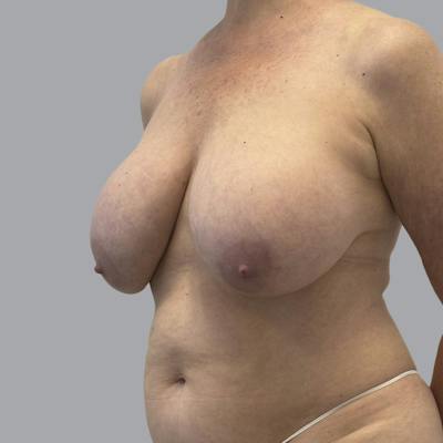 Breast Implant Removal Before & After Gallery - Patient 380462 - Image 3
