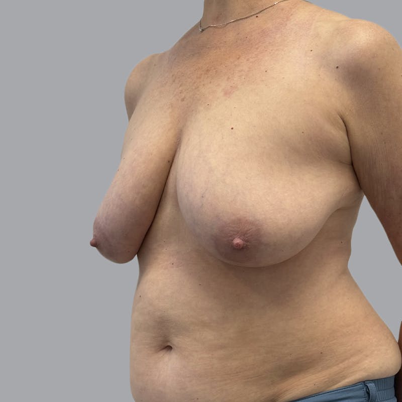 Breast Implant Removal Before & After Gallery - Patient 380462 - Image 4