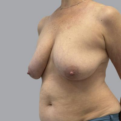 Breast Implant Removal Before & After Gallery - Patient 380462 - Image 4