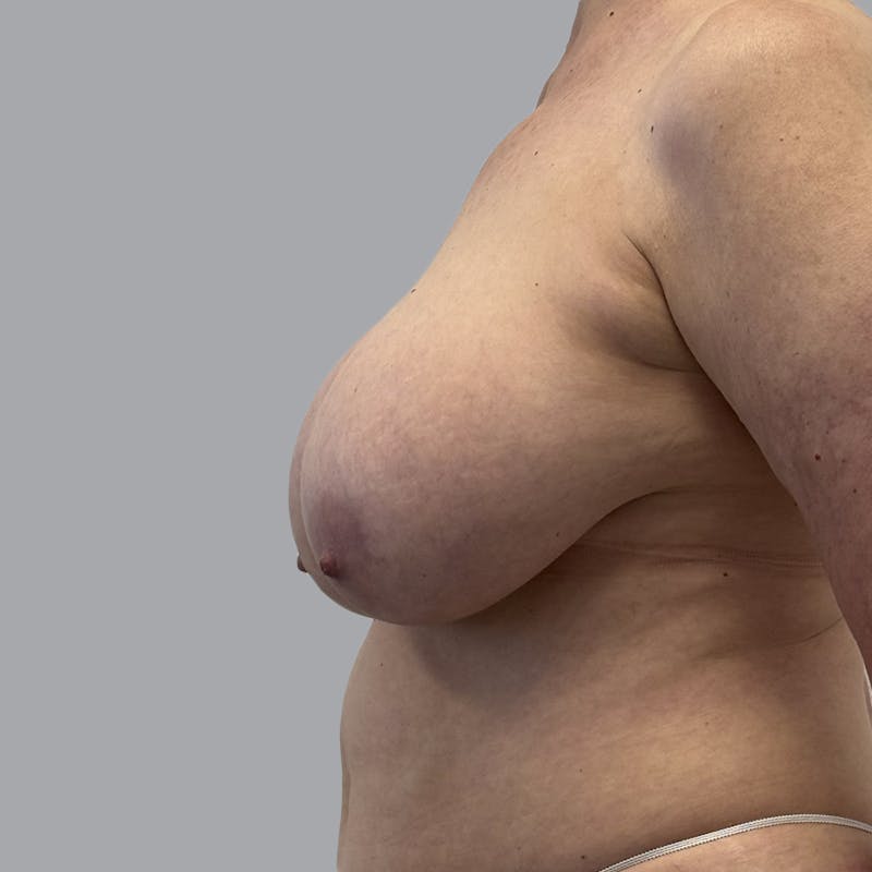 Breast Implant Removal Before & After Gallery - Patient 380462 - Image 5