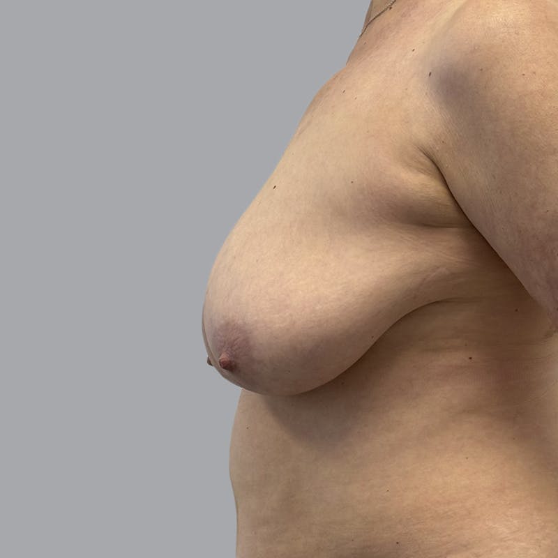 Breast Implant Removal Before & After Gallery - Patient 380462 - Image 6