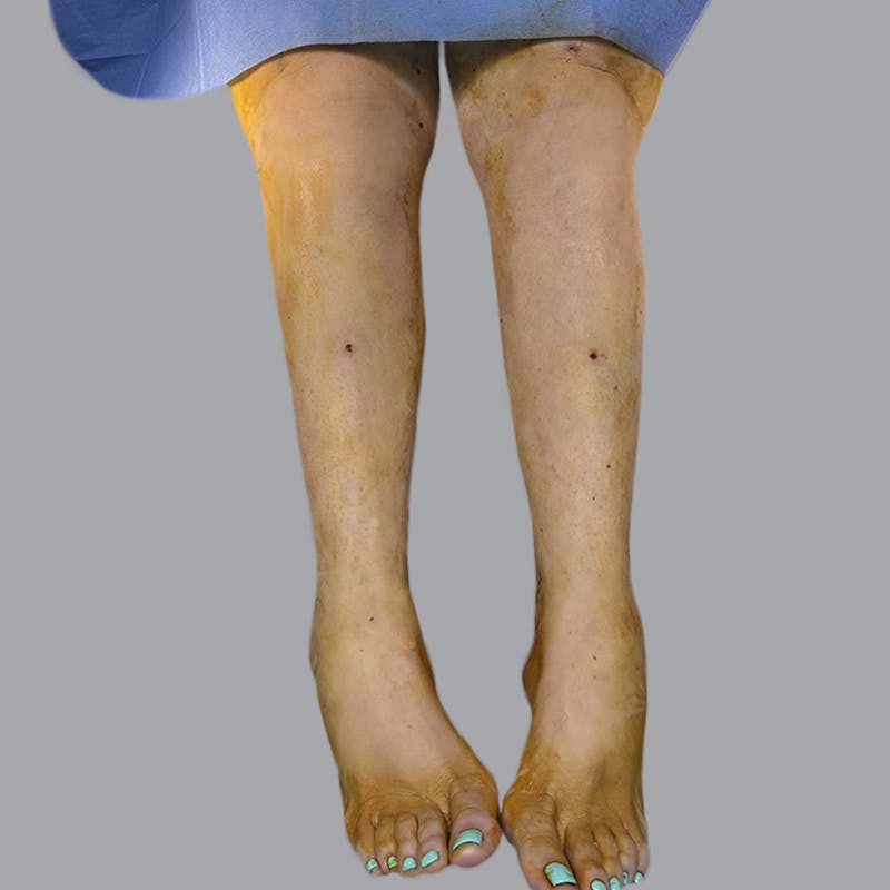Lipedema Before & After Gallery - Patient 311514 - Image 2