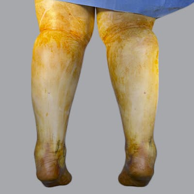 Lipedema Before & After Gallery - Patient 311514 - Image 3