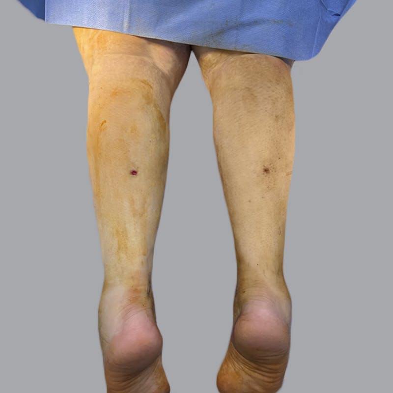 Lipedema Before & After Gallery - Patient 311514 - Image 4