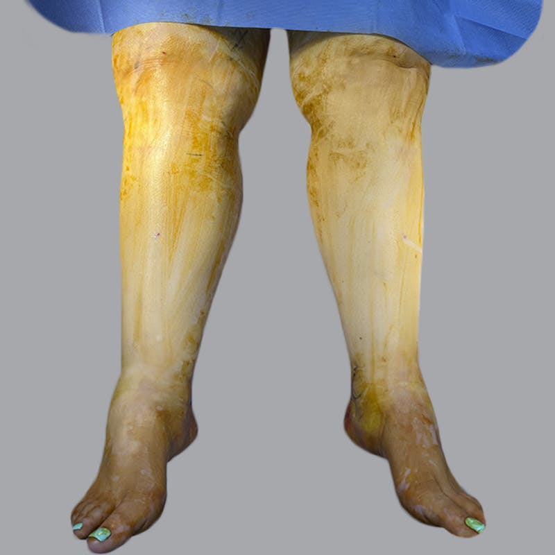 Lipedema Before & After Gallery - Patient 311514 - Image 1