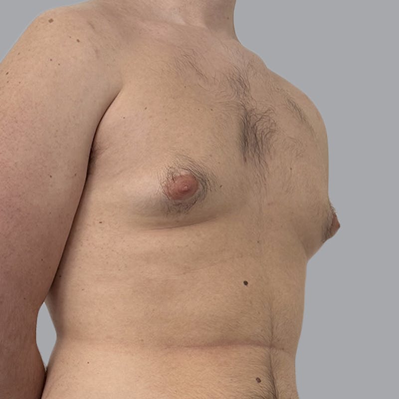 Gynecomastia Before & After Gallery - Patient 312178 - Image 3
