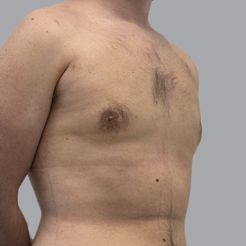 Gynecomastia Before & After Gallery - Patient 312178 - Image 4