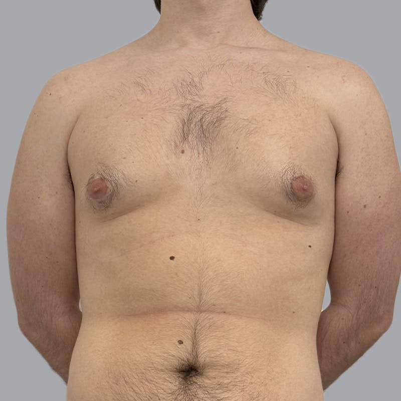 Gynecomastia Before & After Gallery - Patient 312178 - Image 1