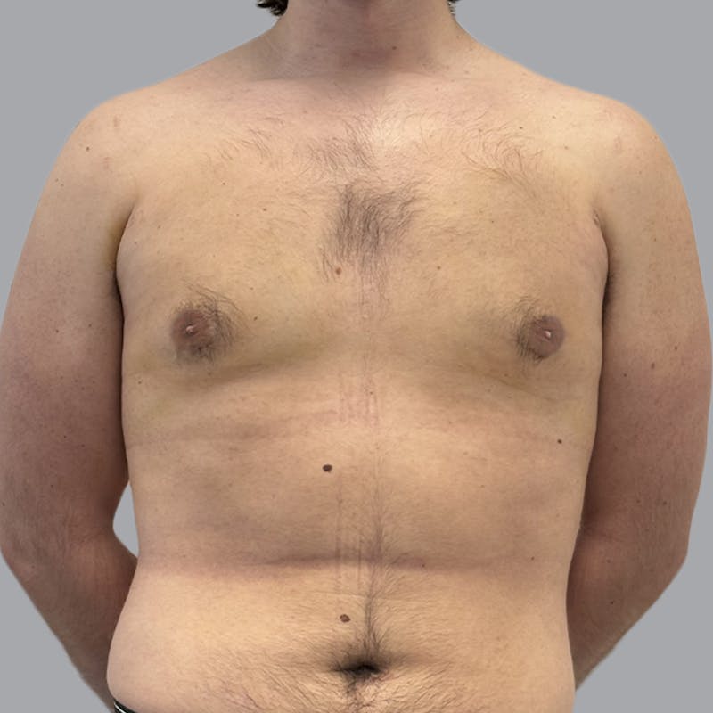 Gynecomastia Before & After Gallery - Patient 312178 - Image 2